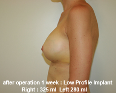 plastic-surgery-breast-augmentation